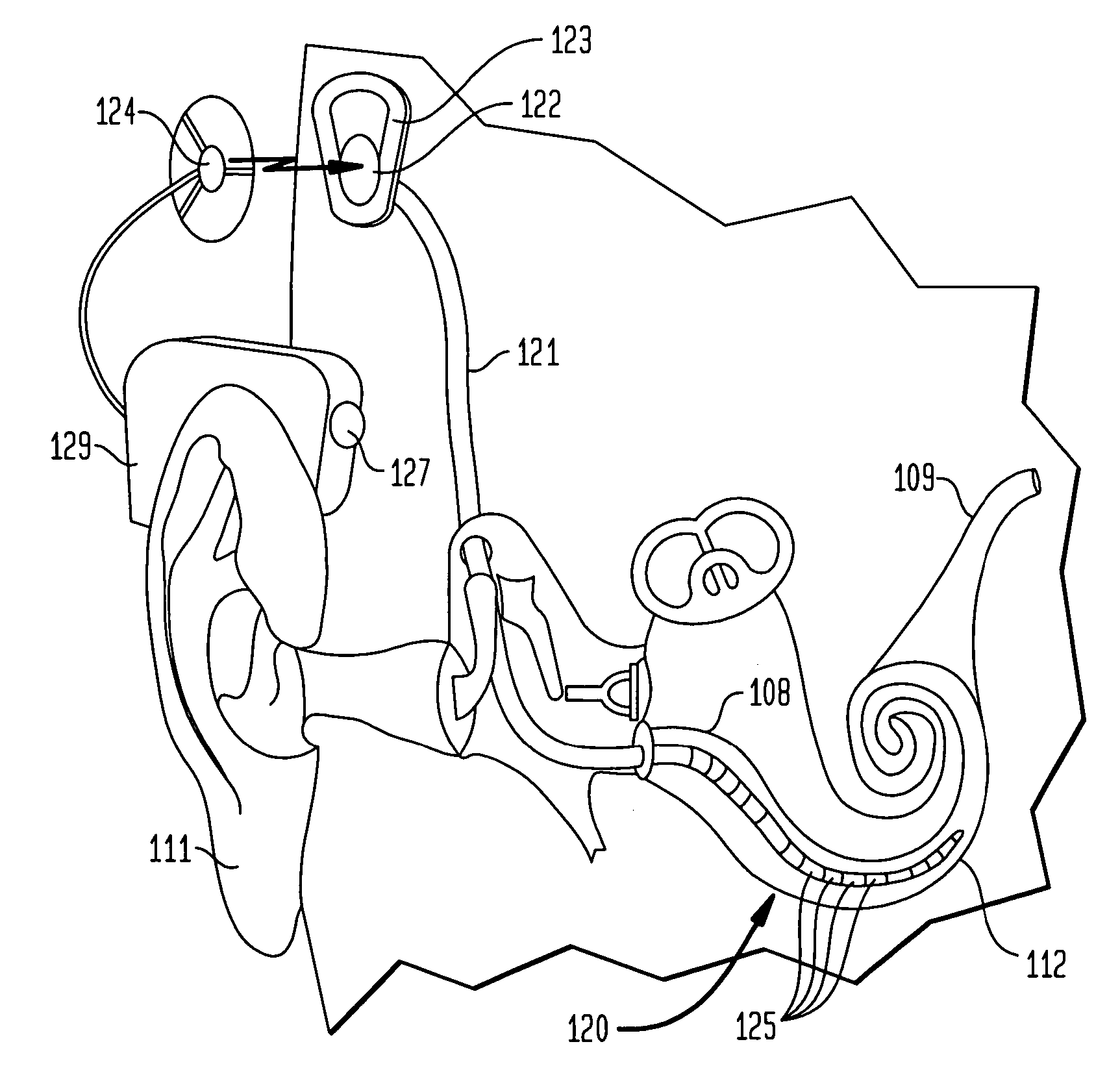 Simultaneous delivery of electrical and acoustical stimulation in a hearing prosthesis