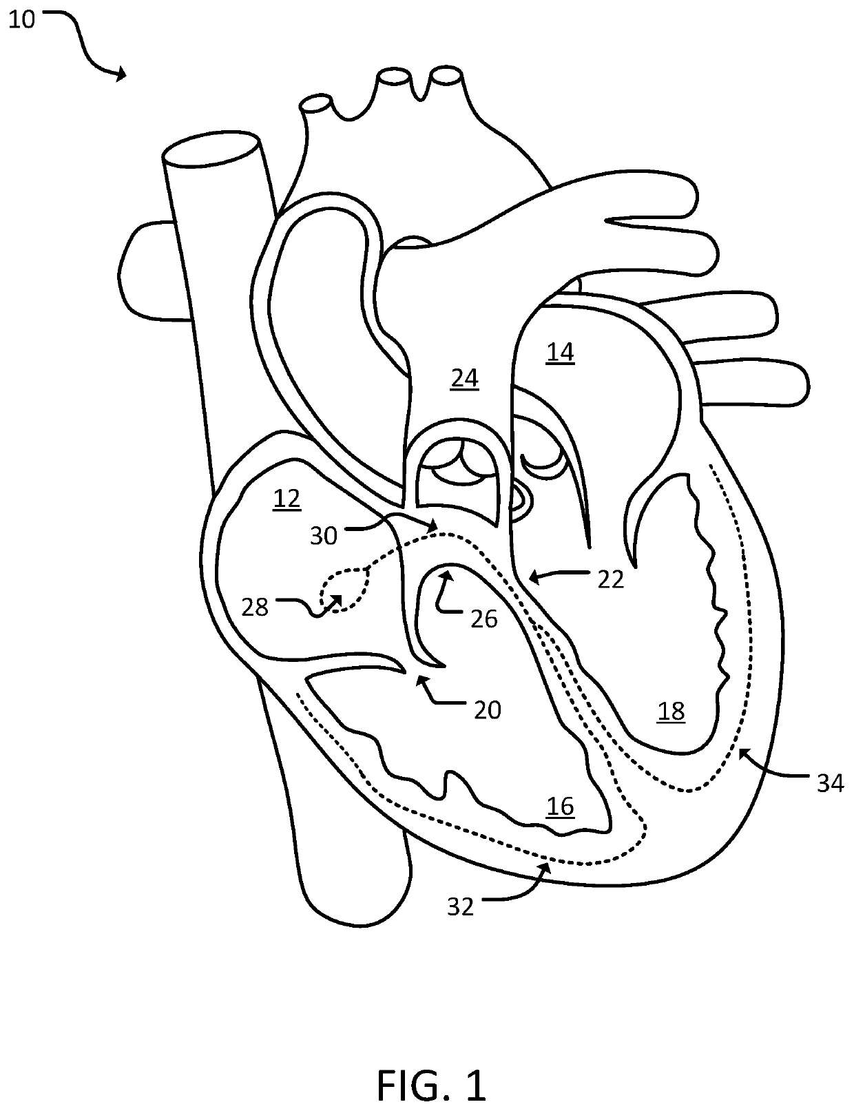 Devices and methods for cardiac pacing and resynchronization