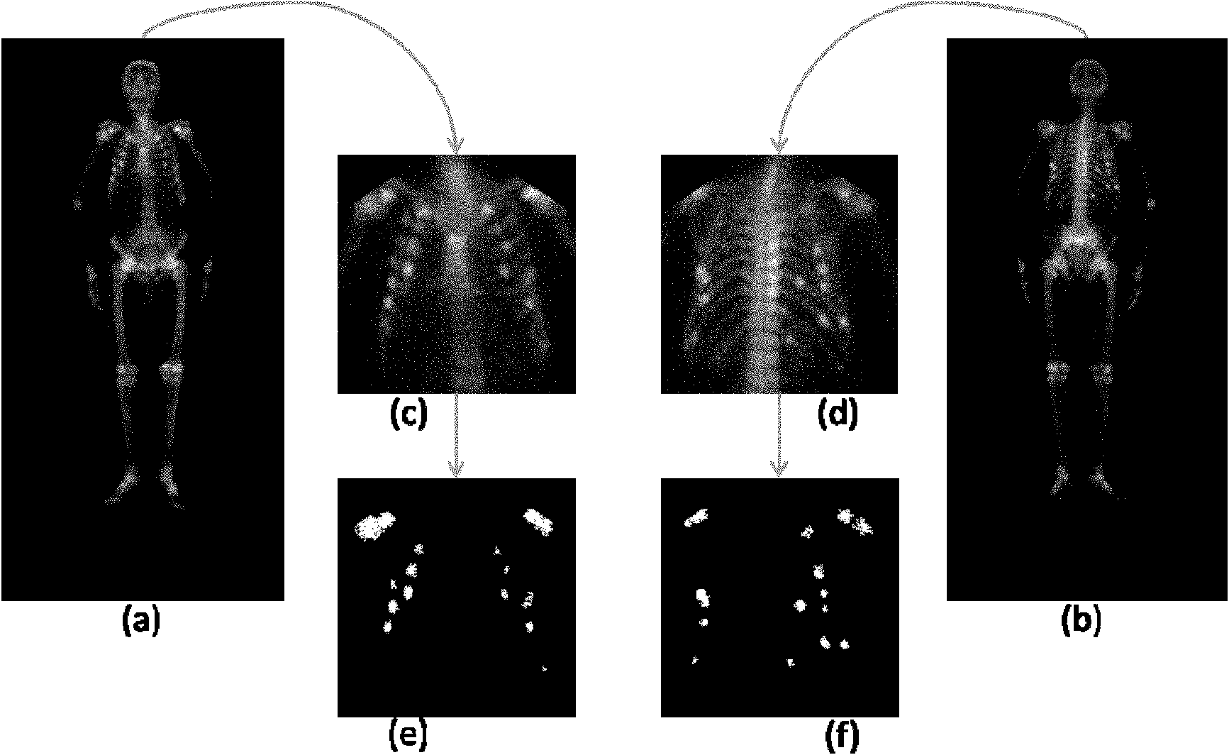 Method for recognizing image of carcinoma bone metastasis in bone scan