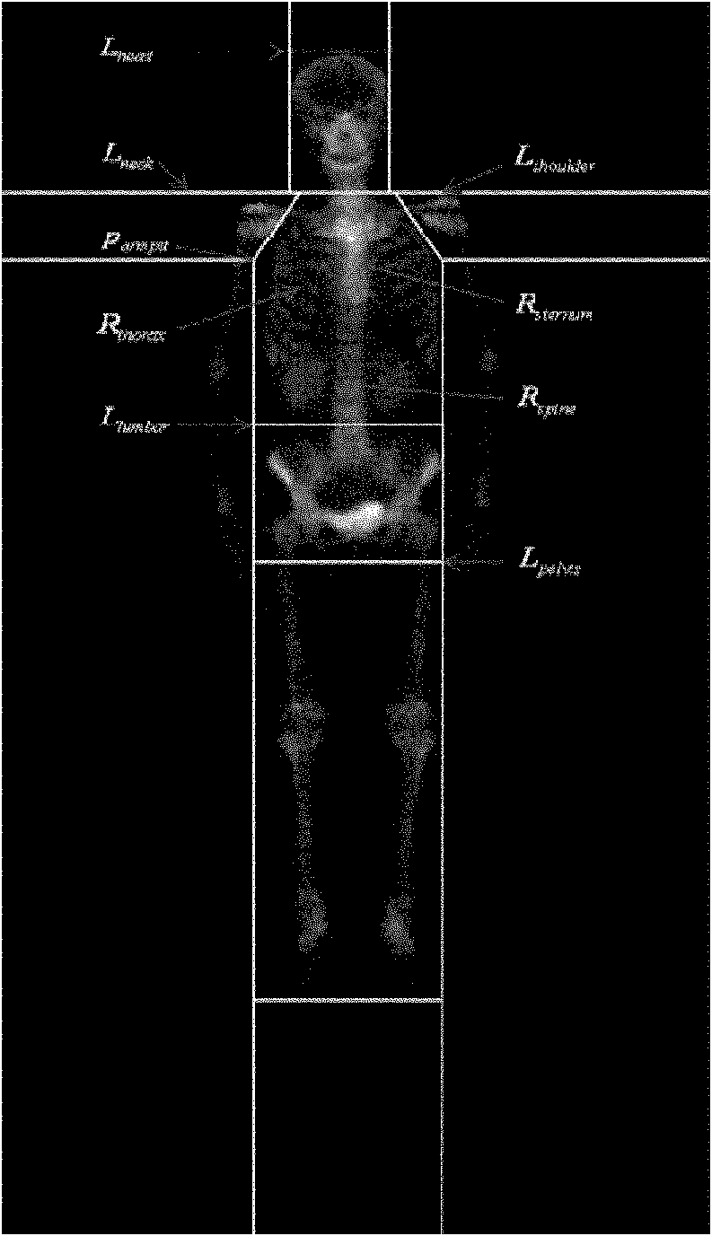 Method for recognizing image of carcinoma bone metastasis in bone scan