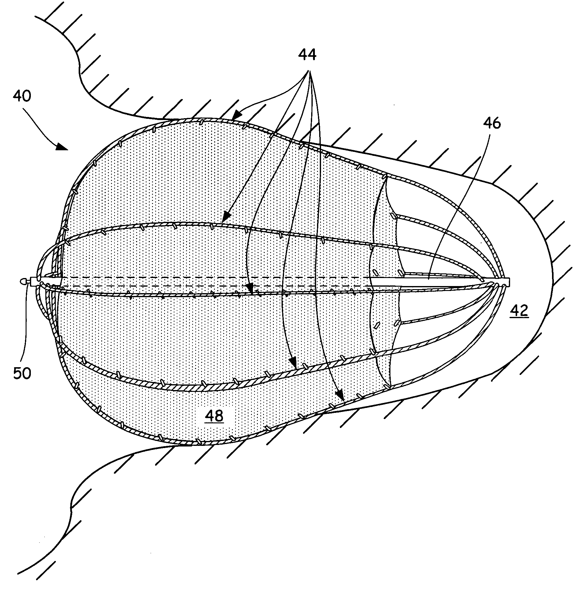 Left atrial appendage closure device