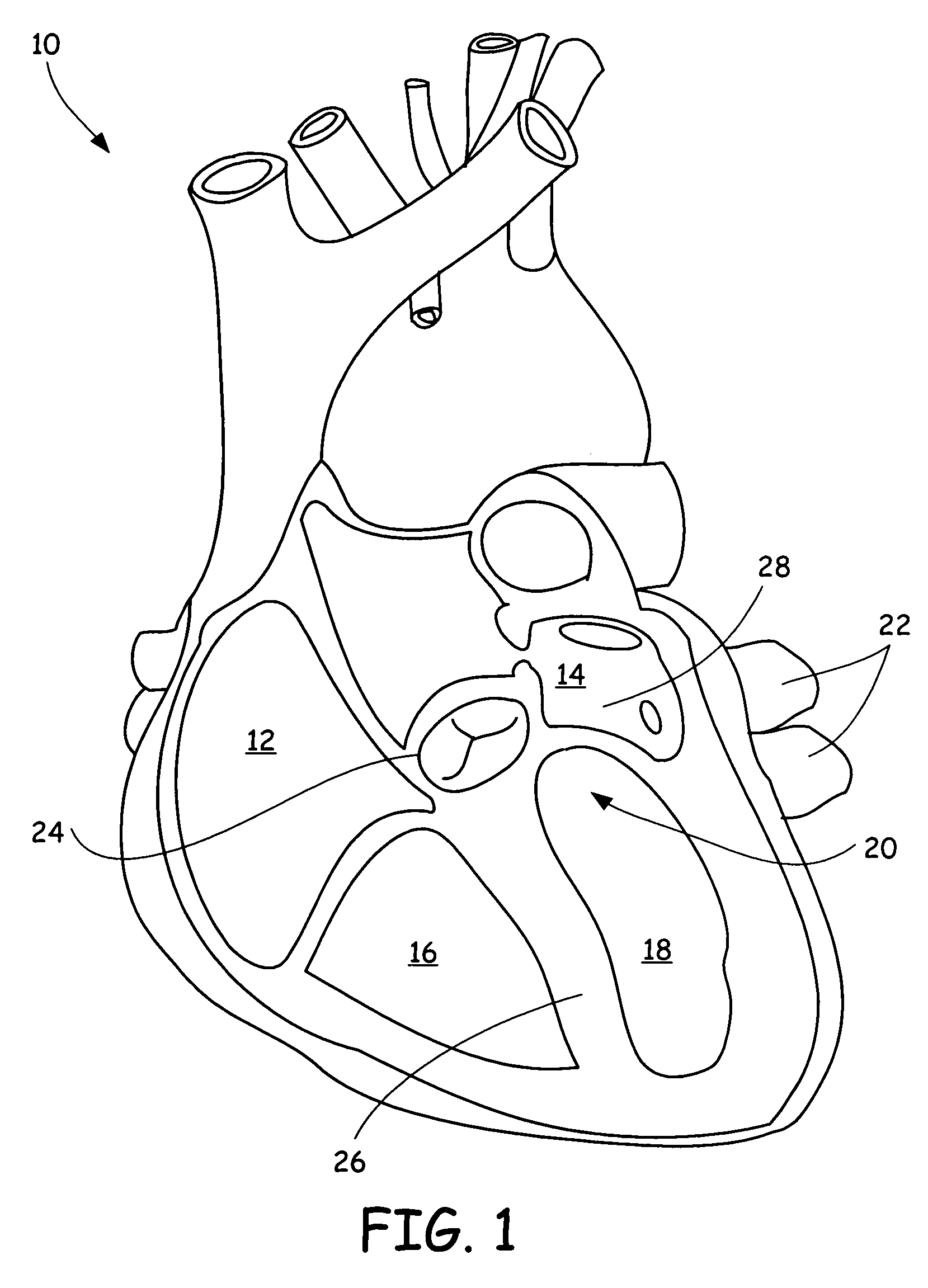 Left atrial appendage closure device