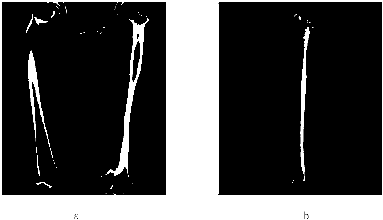 Computer-assistant femoral intertrochanteric fracture positional and alignment semi-automatic restoration method