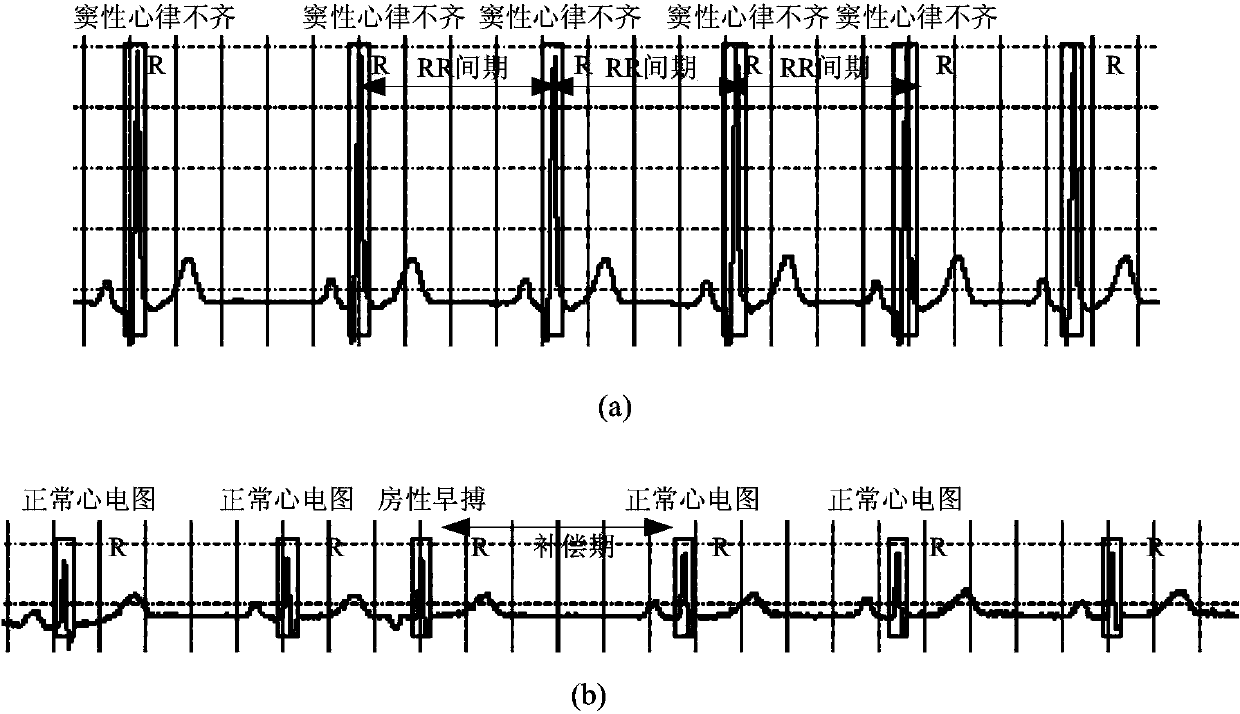 Automatic electrocardiogram recognition system