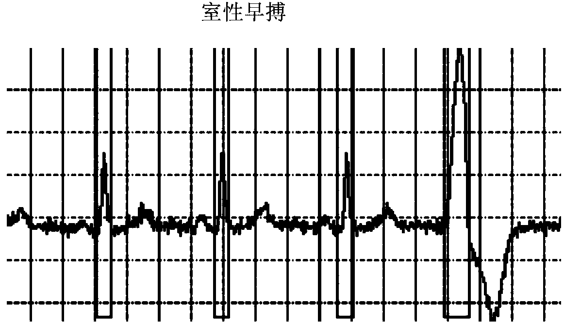 Automatic electrocardiogram recognition system