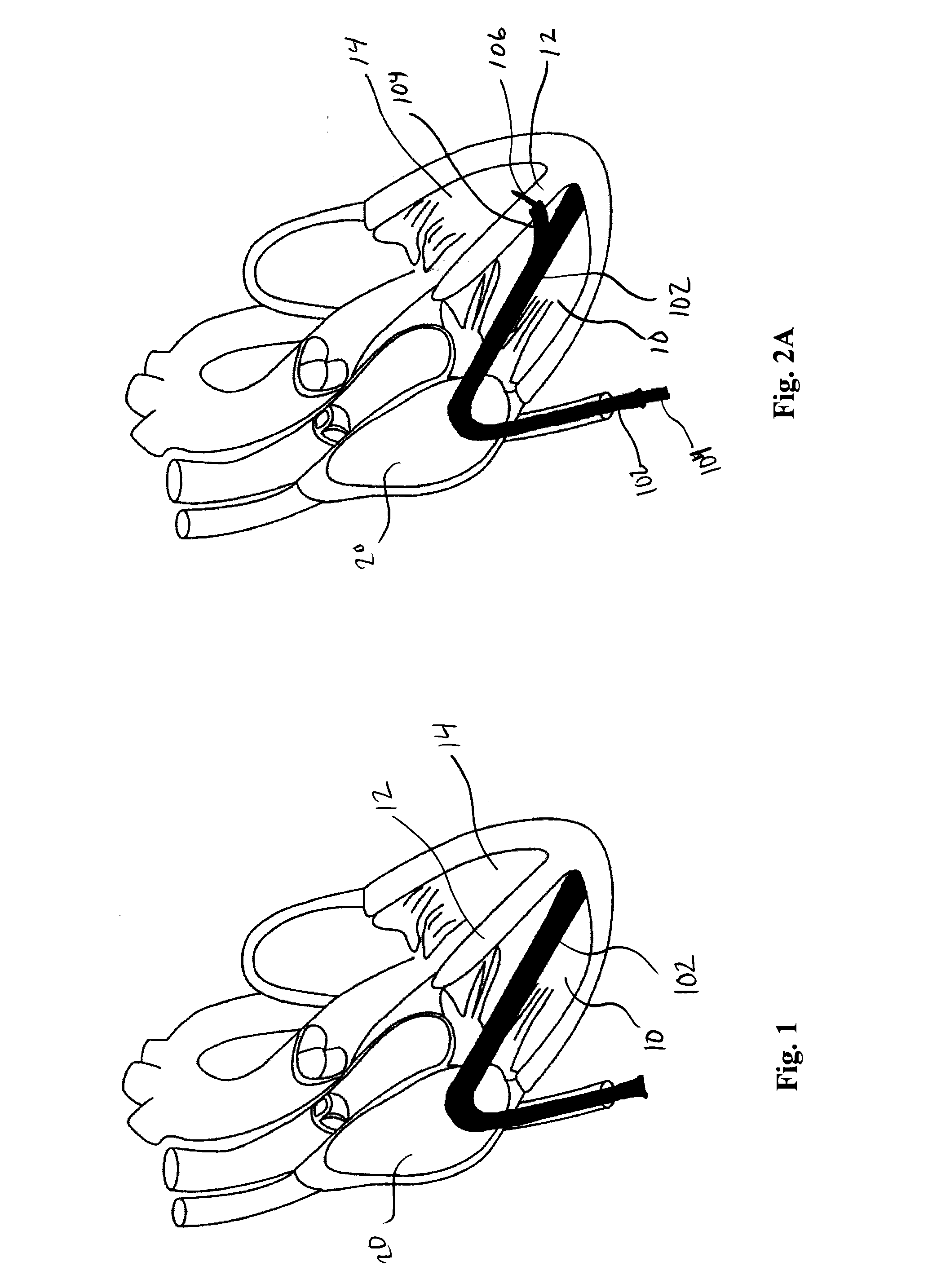 Minimally invasive repair of heart valve leaflets