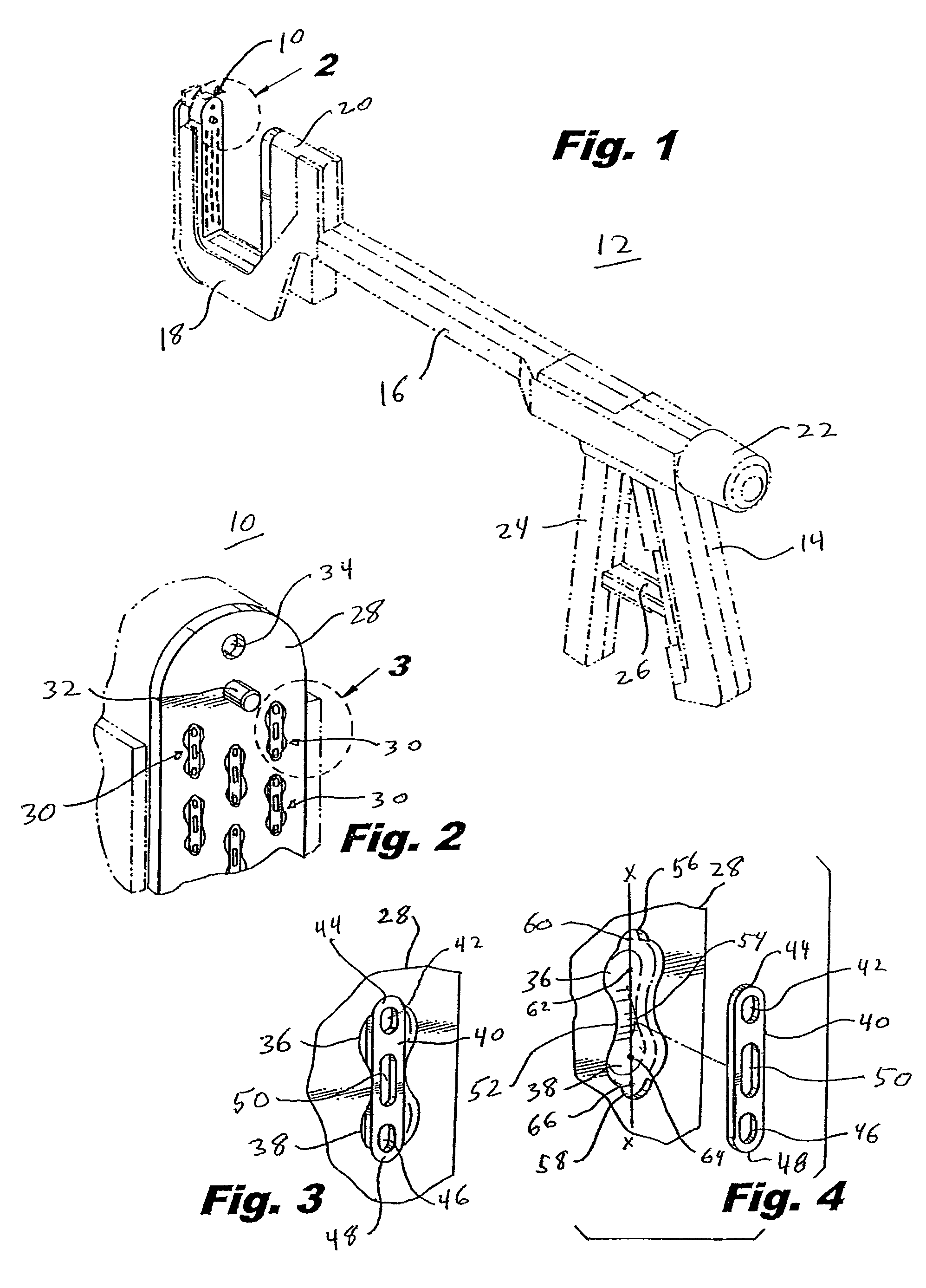 Surgical staple with augmented compression area