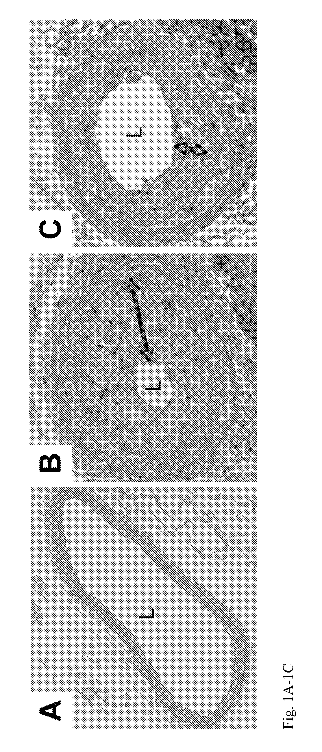 Wnt/beta-catenin inhibitor-eluting endovascular stent