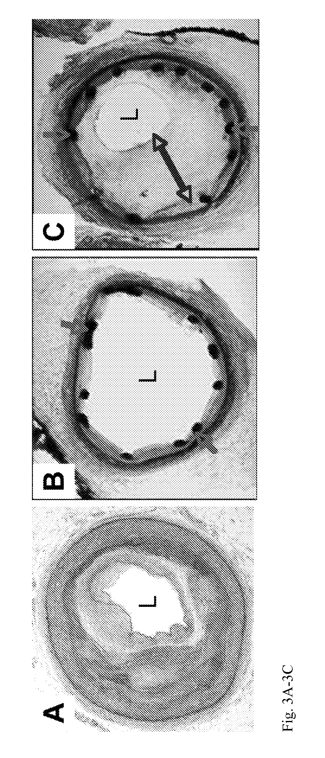 Wnt/beta-catenin inhibitor-eluting endovascular stent