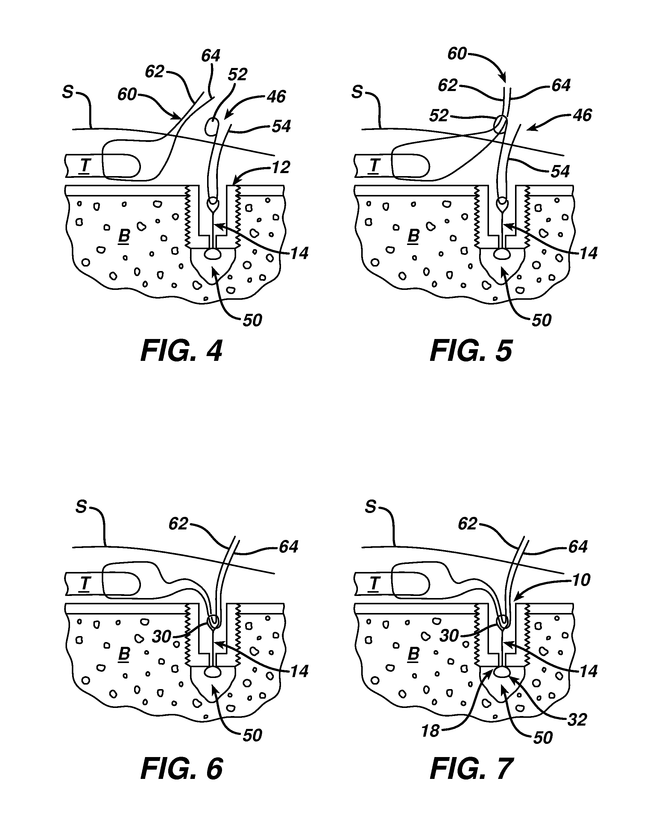 Surgical filament snare assemblies