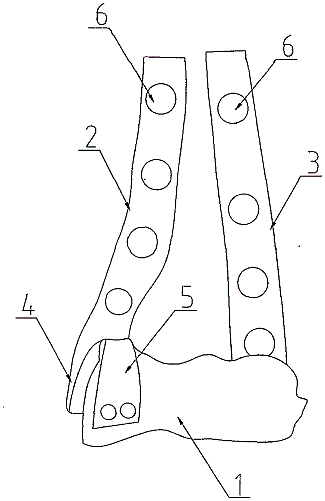 Artificial elbow joint surface replacement prosthesis