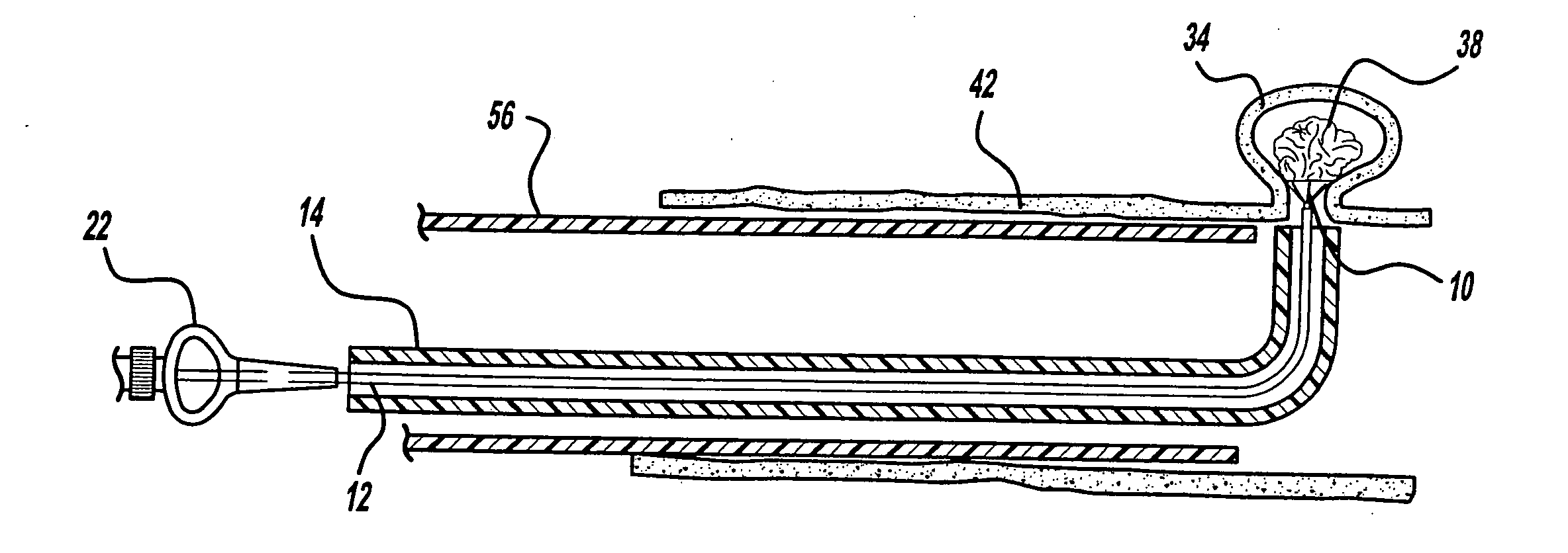 Aneurysm embolic device with an occlusive member