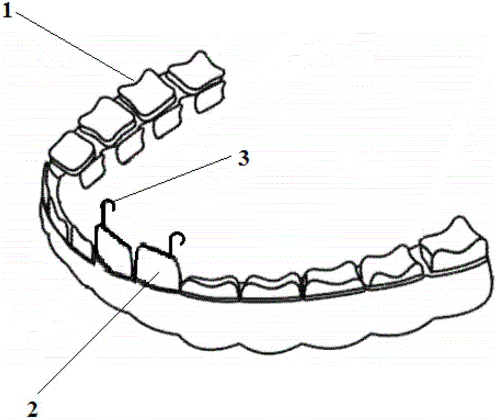 Tooth protector for assisting laryngoscope intubation