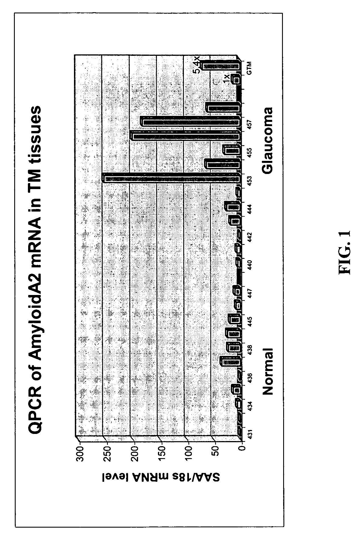 Use of serum amyloid a gene in diagnosis and treatment of glaucoma and identification of anti-glaucoma agents