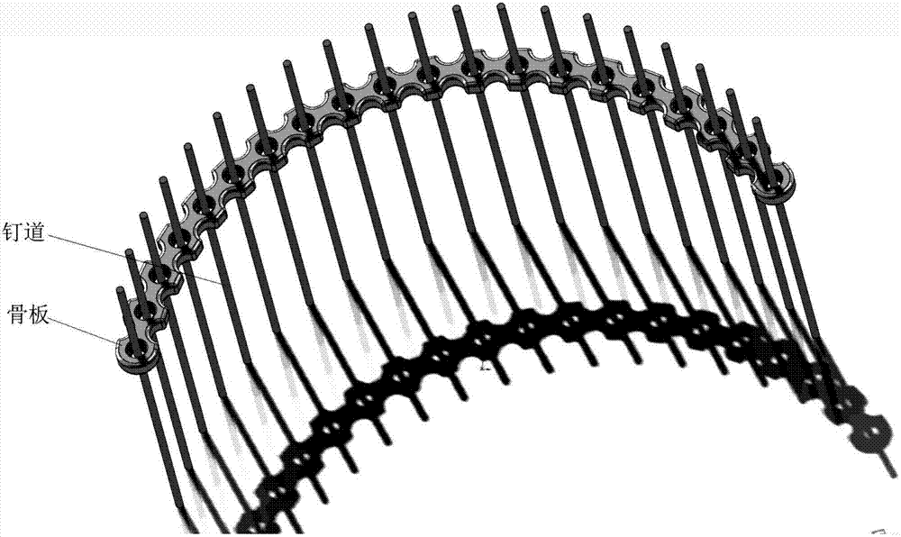 Method for digitalized pre-bending and navigation embedding of acetabulum internal fracture fixation locking reconstruction bone fracture plate