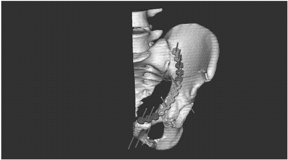 Method for digitalized pre-bending and navigation embedding of acetabulum internal fracture fixation locking reconstruction bone fracture plate