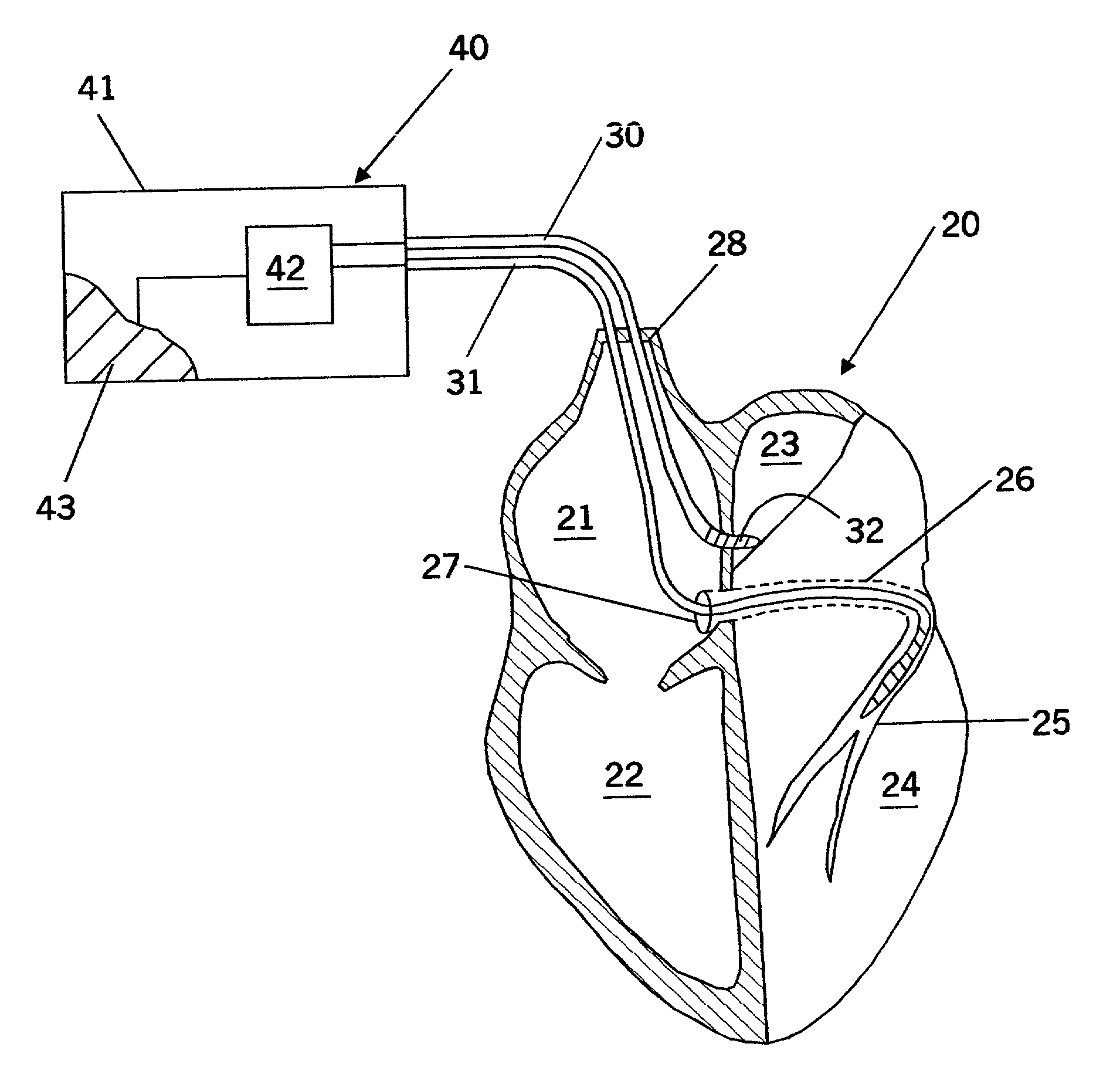 Inter-atrial septum or superior vena cava electrodes for atrial defibrillation