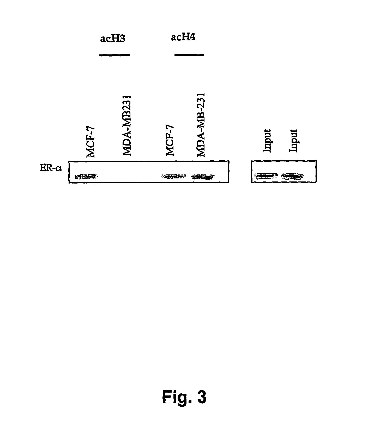 Methods of diagnosing, prognosing and treating breast cancer