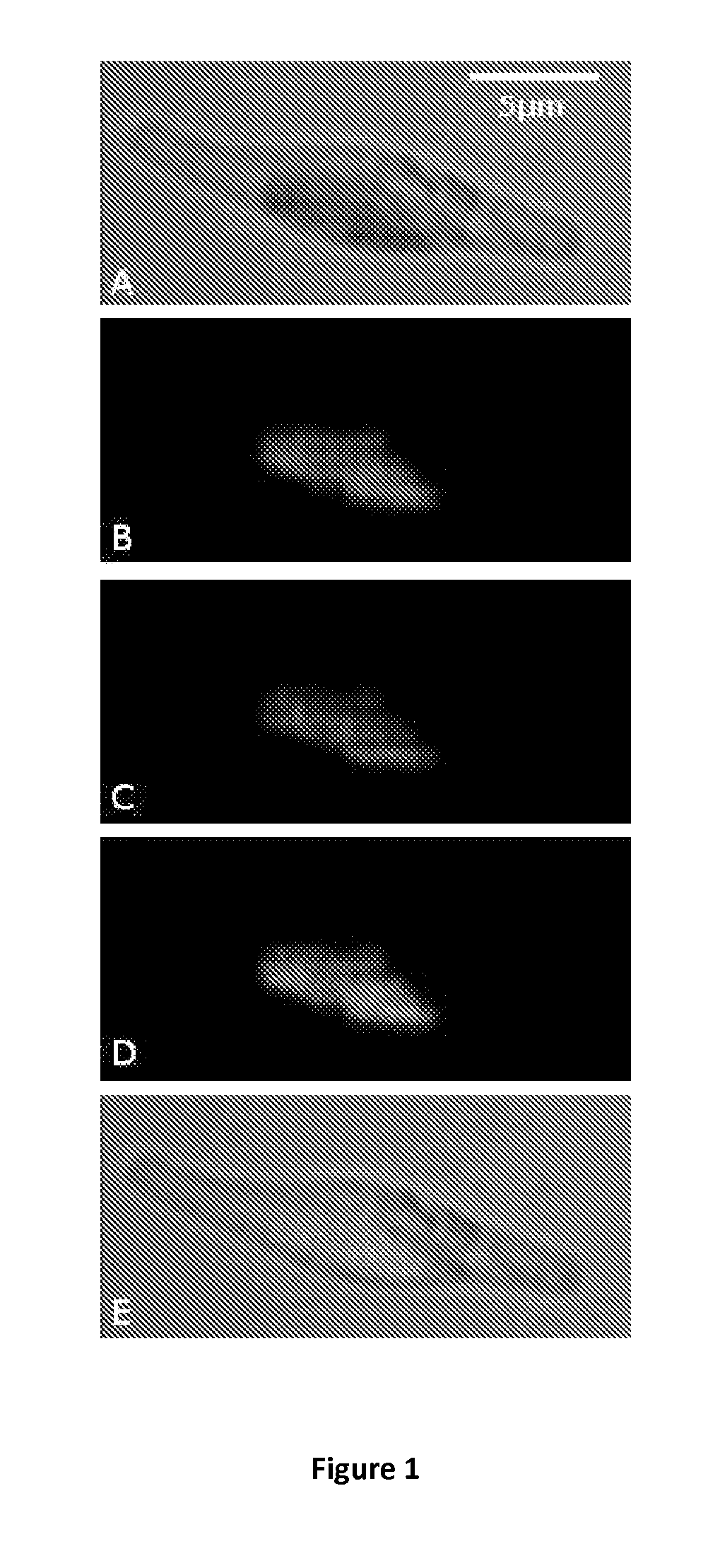 Production of high mannose glycosylated proteins stored in the plastid of microalgae