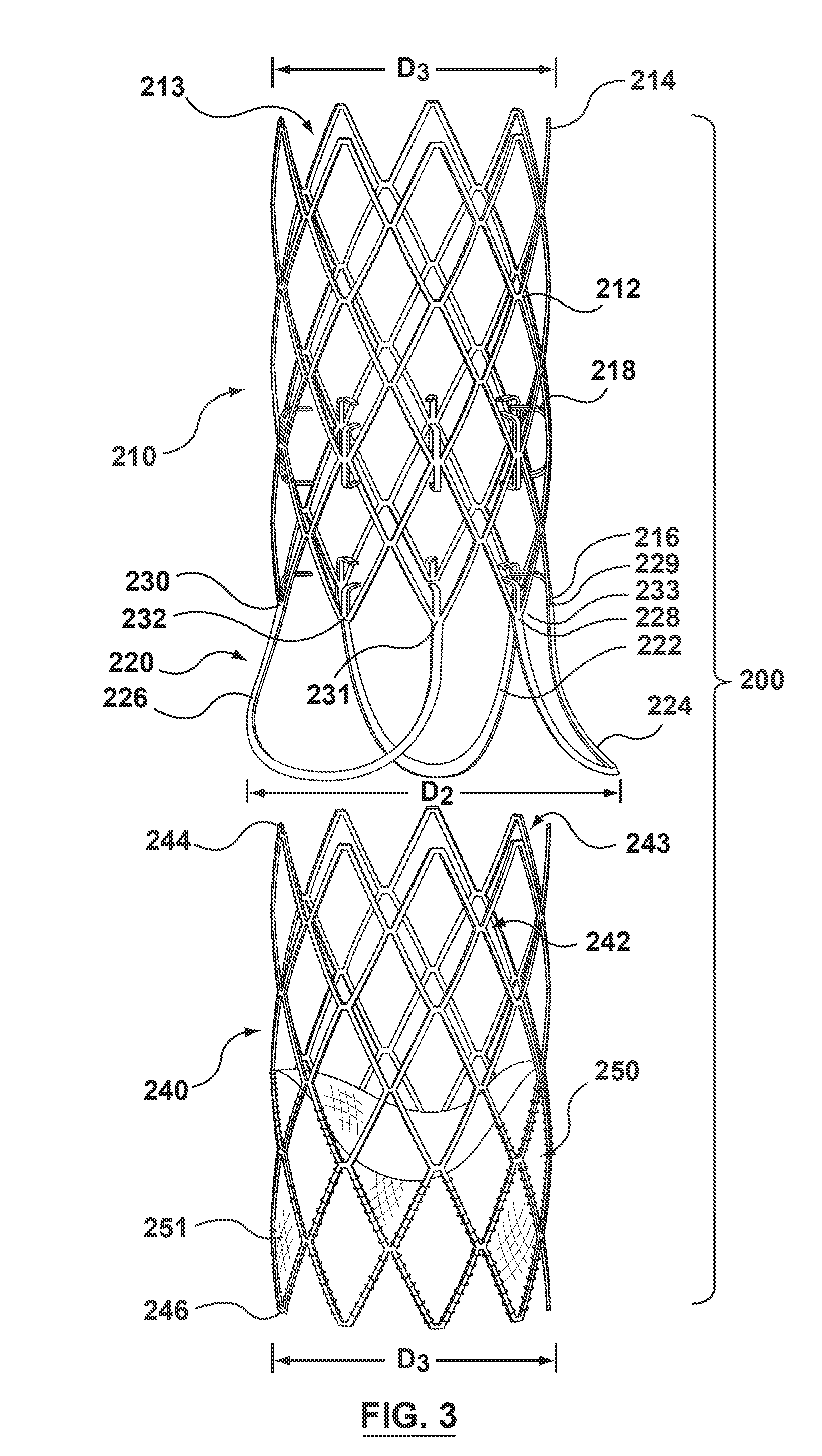 Modular valve prosthesis with anchor stent and valve component