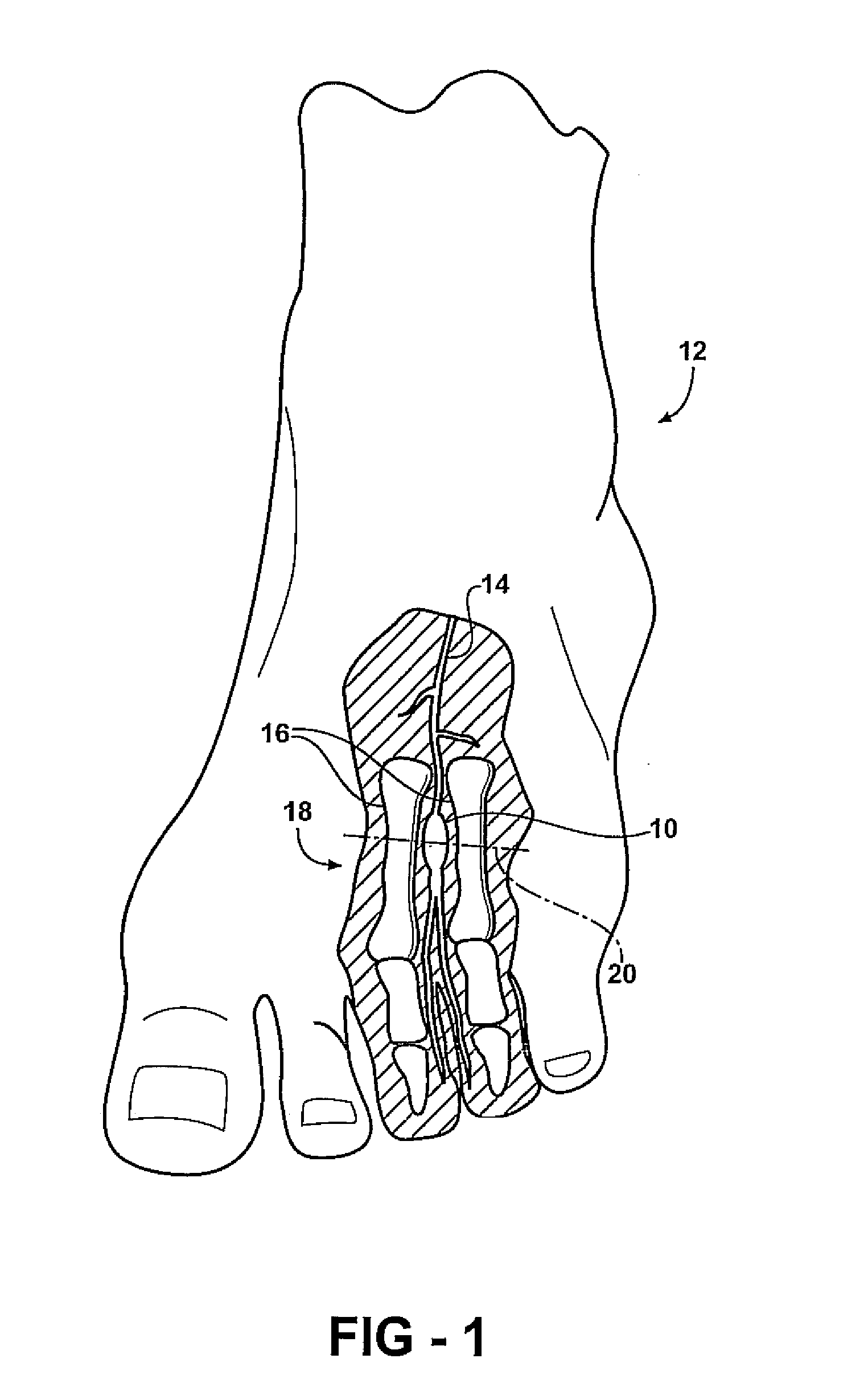 Treatment of lower extremity pain