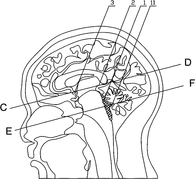 MRI positioning measurement method of anteroposterior diameter and left-right diameter of ventriculus quartus cerebri of human bodies