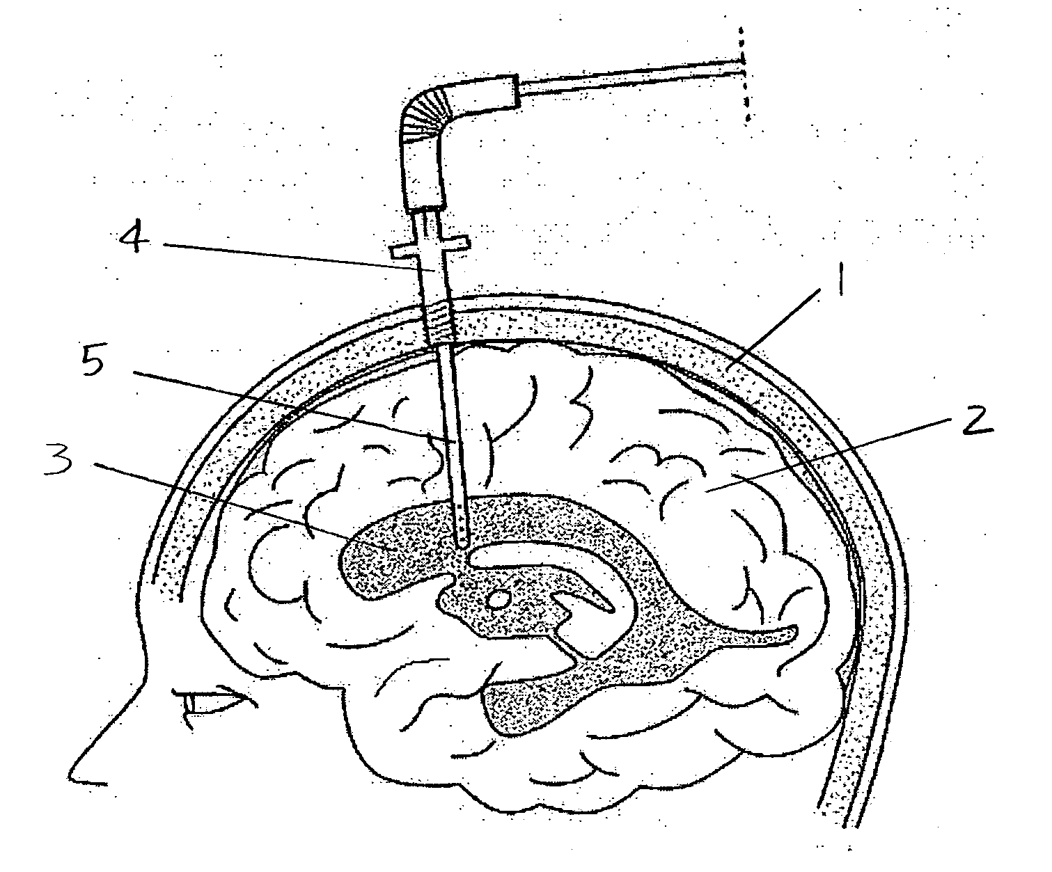 Central nervous system cooling catheter