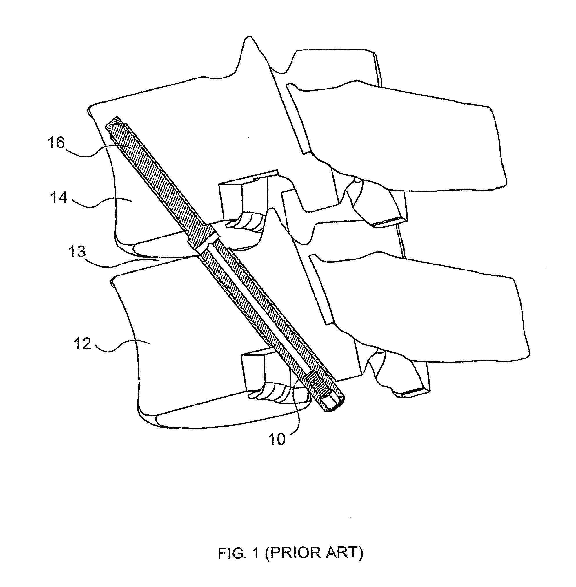 Segmented insert for intervertebral support