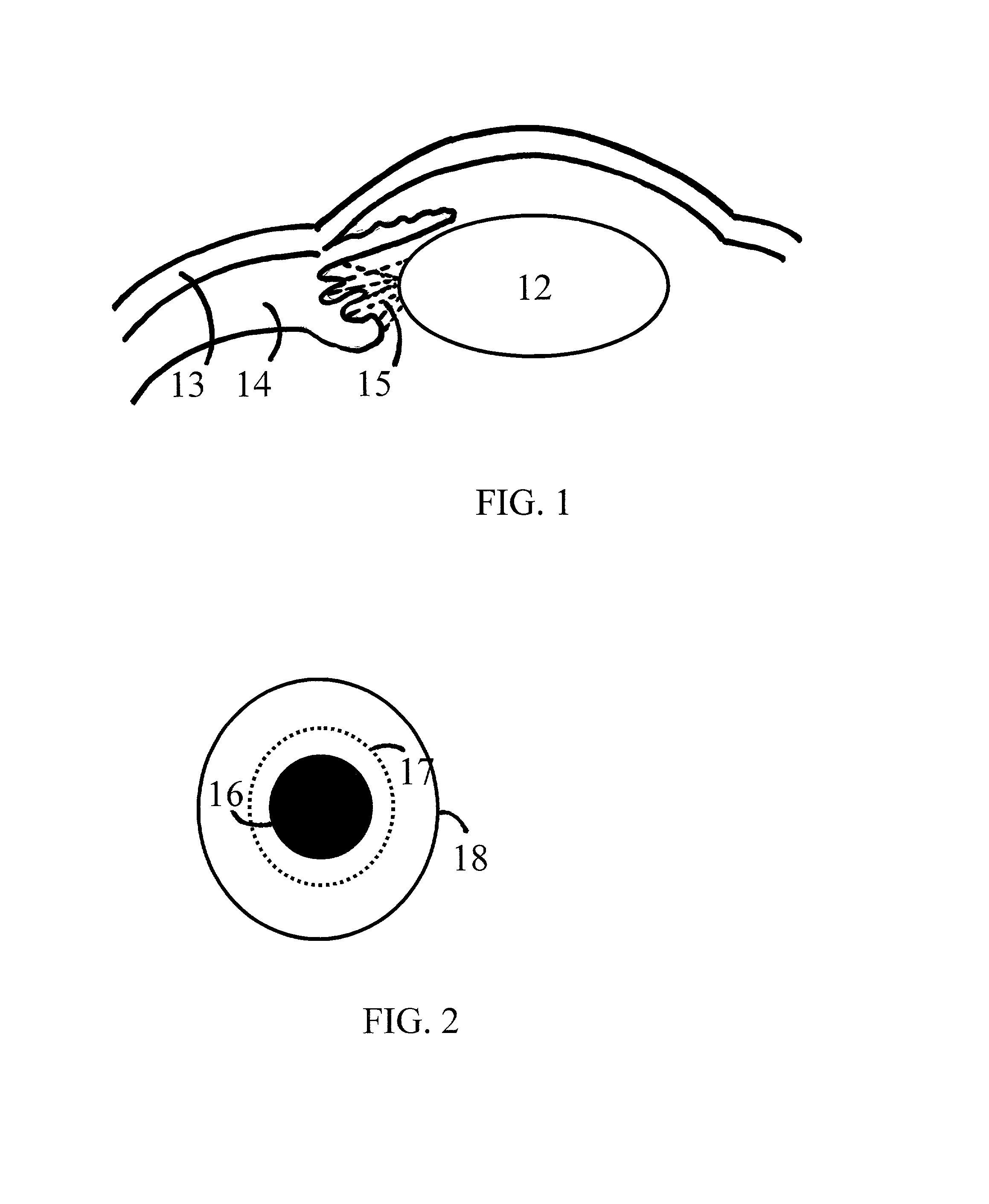 Methods and apparatus for presbyopia correction using ultraviolet and infrared lasers