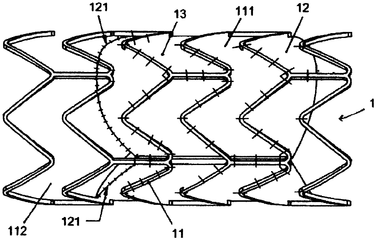 Invasive prosthetic heart valve