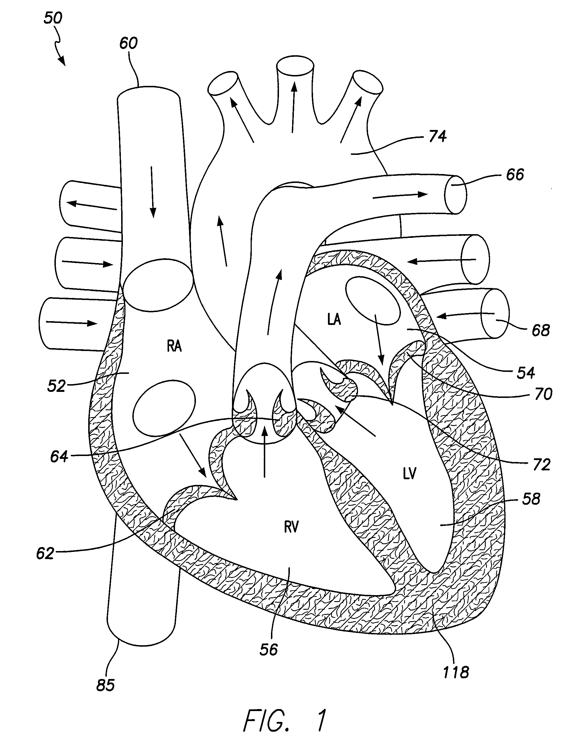 Unitary dual-chamber leadless intra-cardiac medical device and method of implanting same