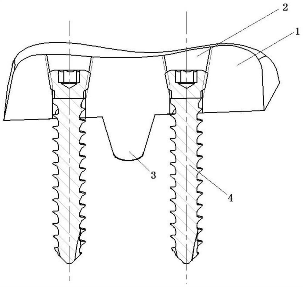 3D-printing-based replacement prosthesis for necrotic surface of talus