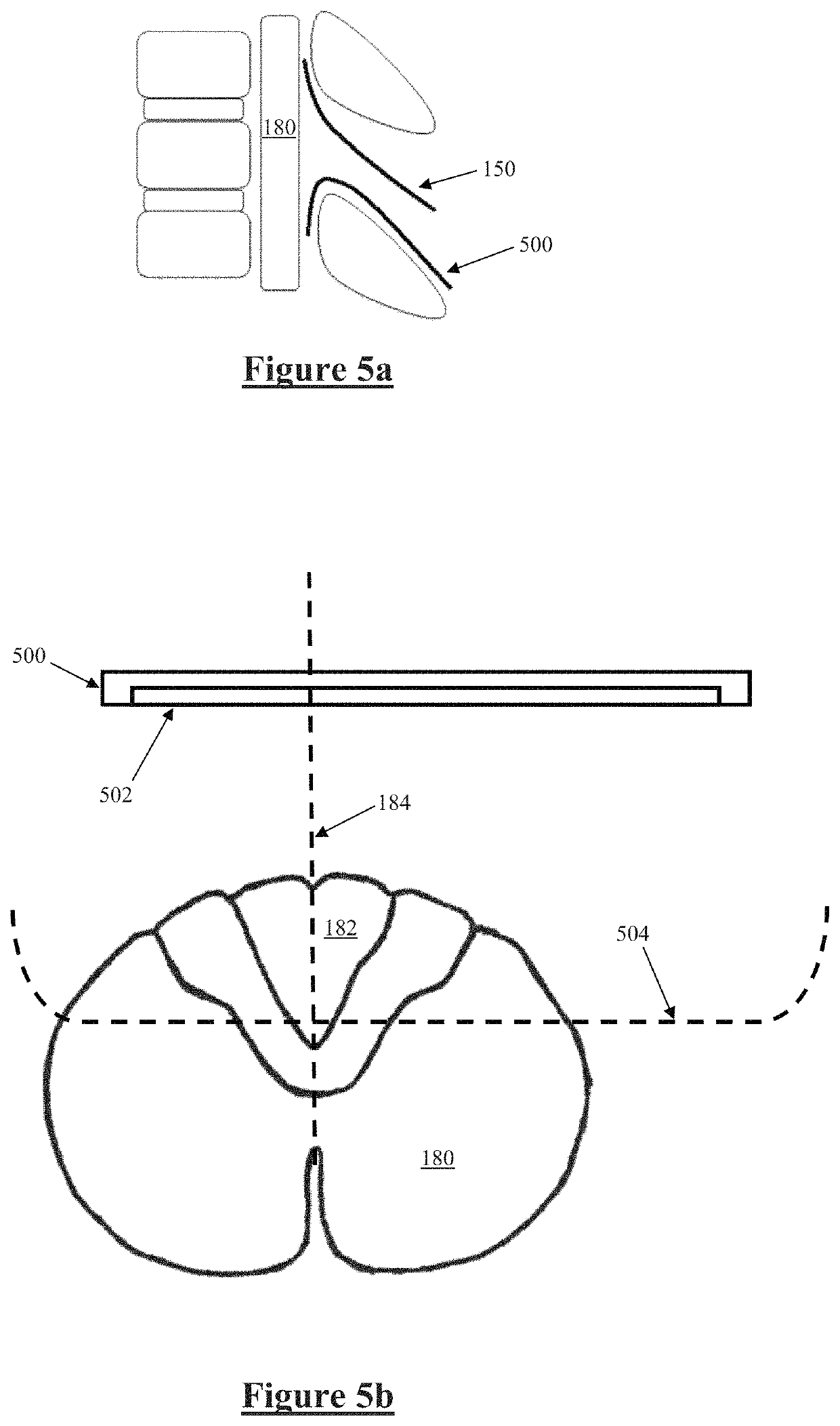 Implantable electrode positioning