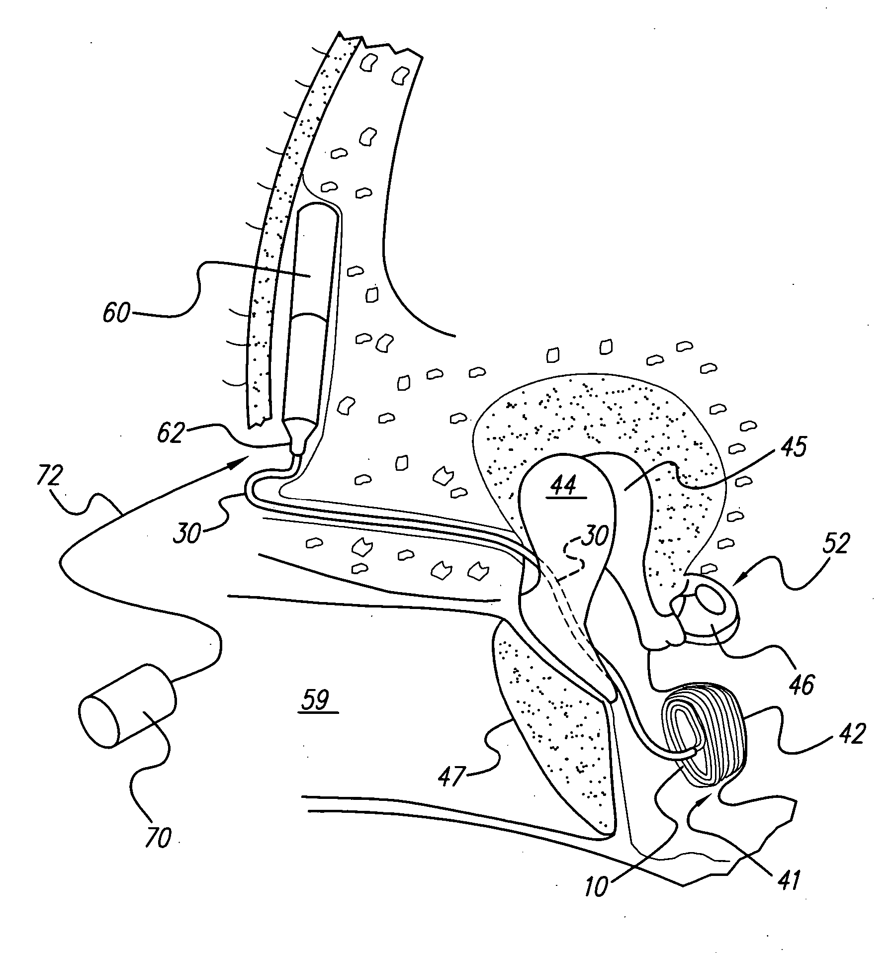 System and method of contra-lateral ear stimulation for preserving neuronal survival and plasticity of the auditory system prior to permanent intra-cochlear implantation