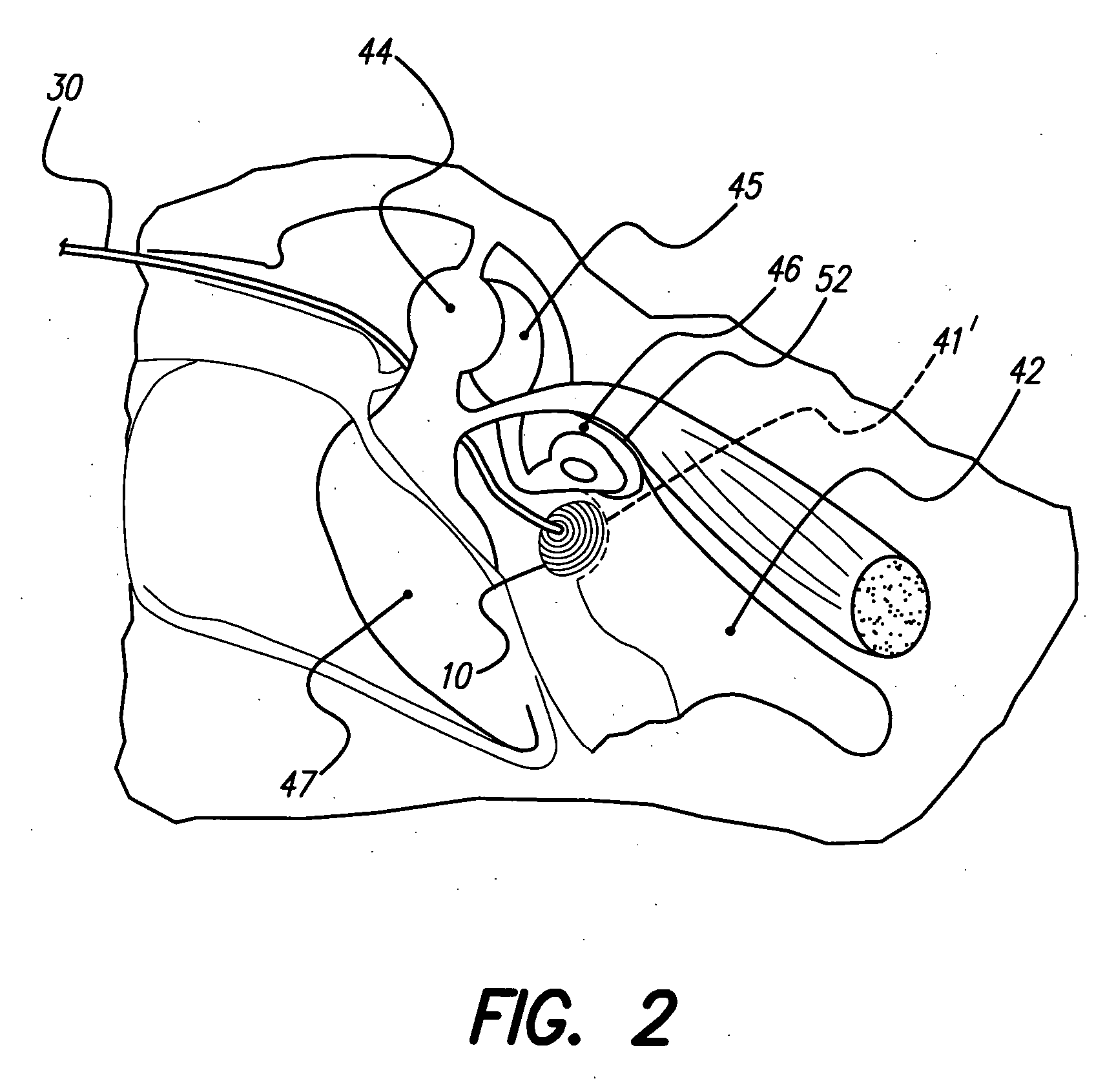 System and method of contra-lateral ear stimulation for preserving neuronal survival and plasticity of the auditory system prior to permanent intra-cochlear implantation