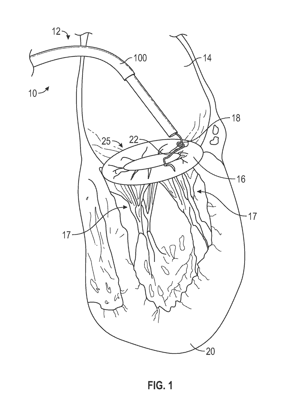 Method and apparatus for transvascular implantation of neo chordae tendinae