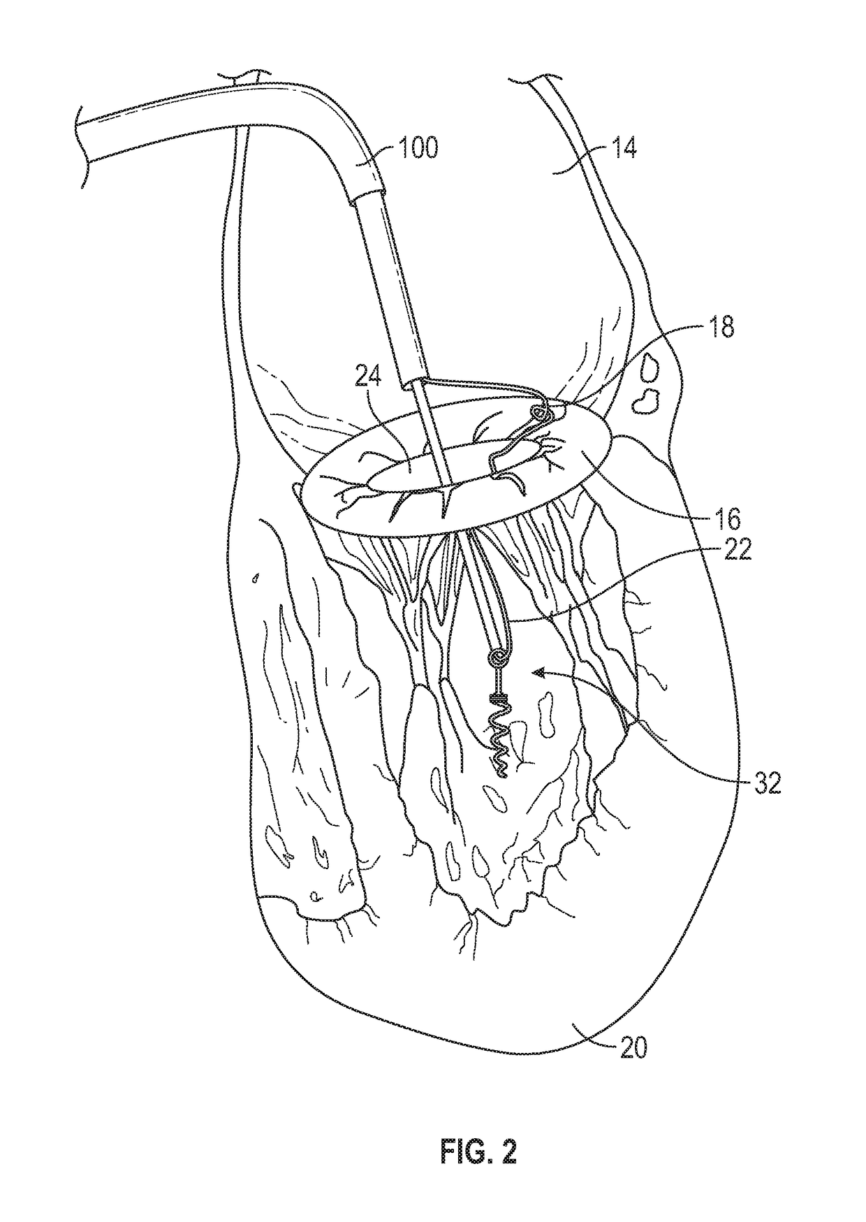 Method and apparatus for transvascular implantation of neo chordae tendinae