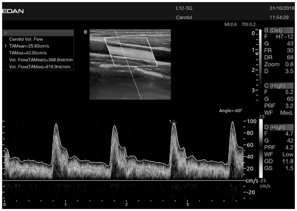 Blood flow automatic measurement method and device based on ultrasonic image