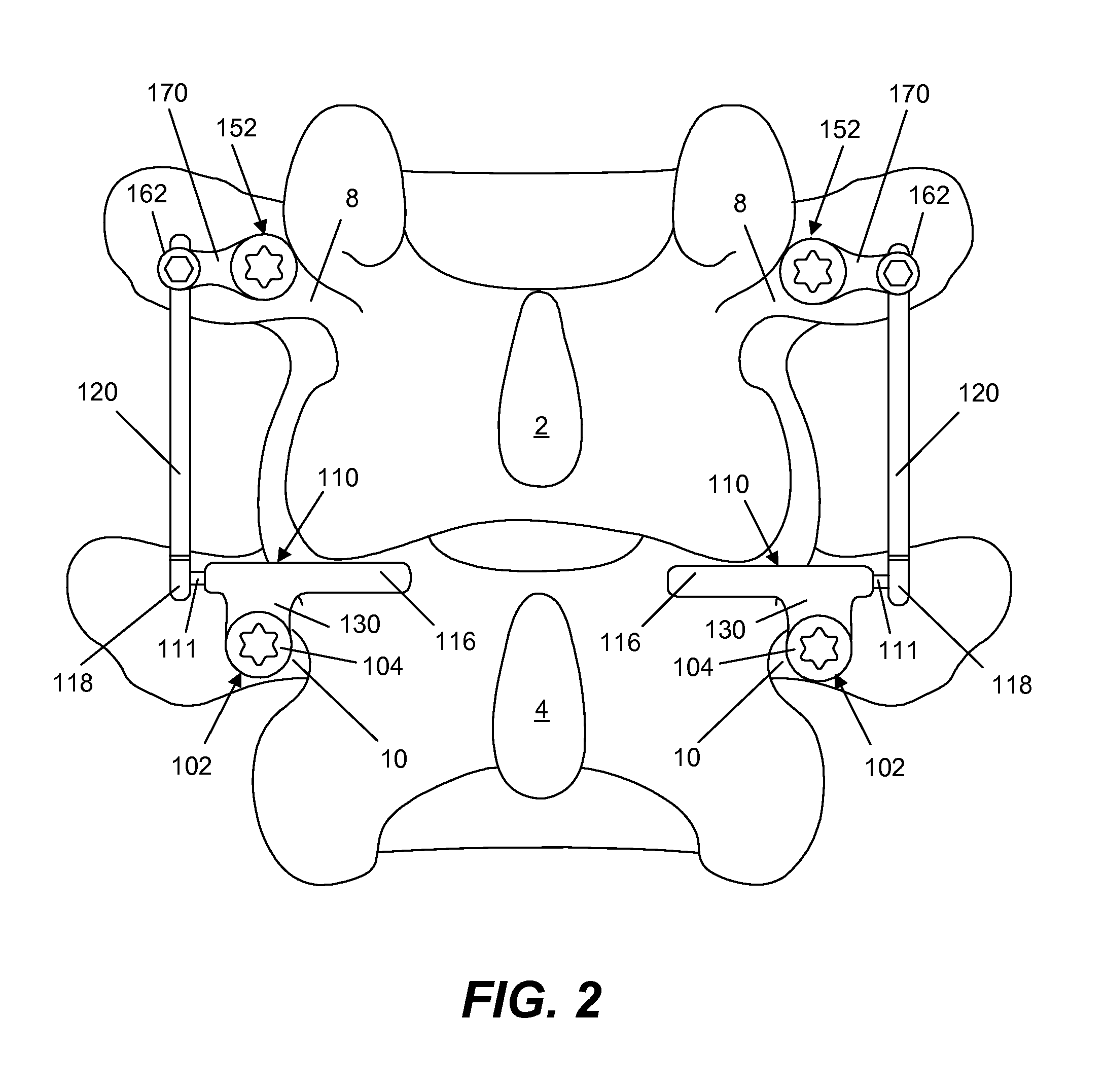 Spine implant with a deflection rod system and connecting linkages and method