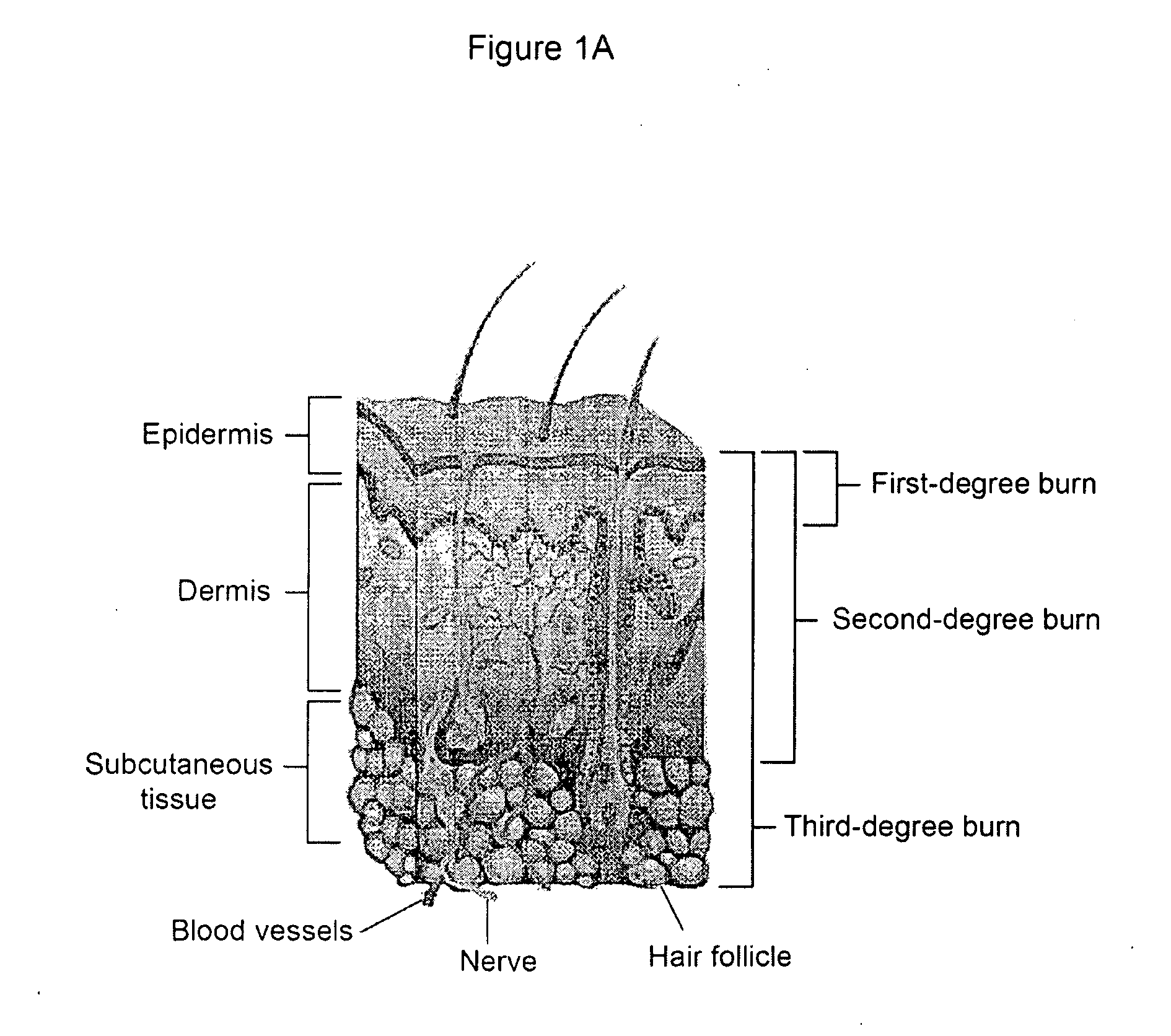 Compositions and Methods for Treating Burns