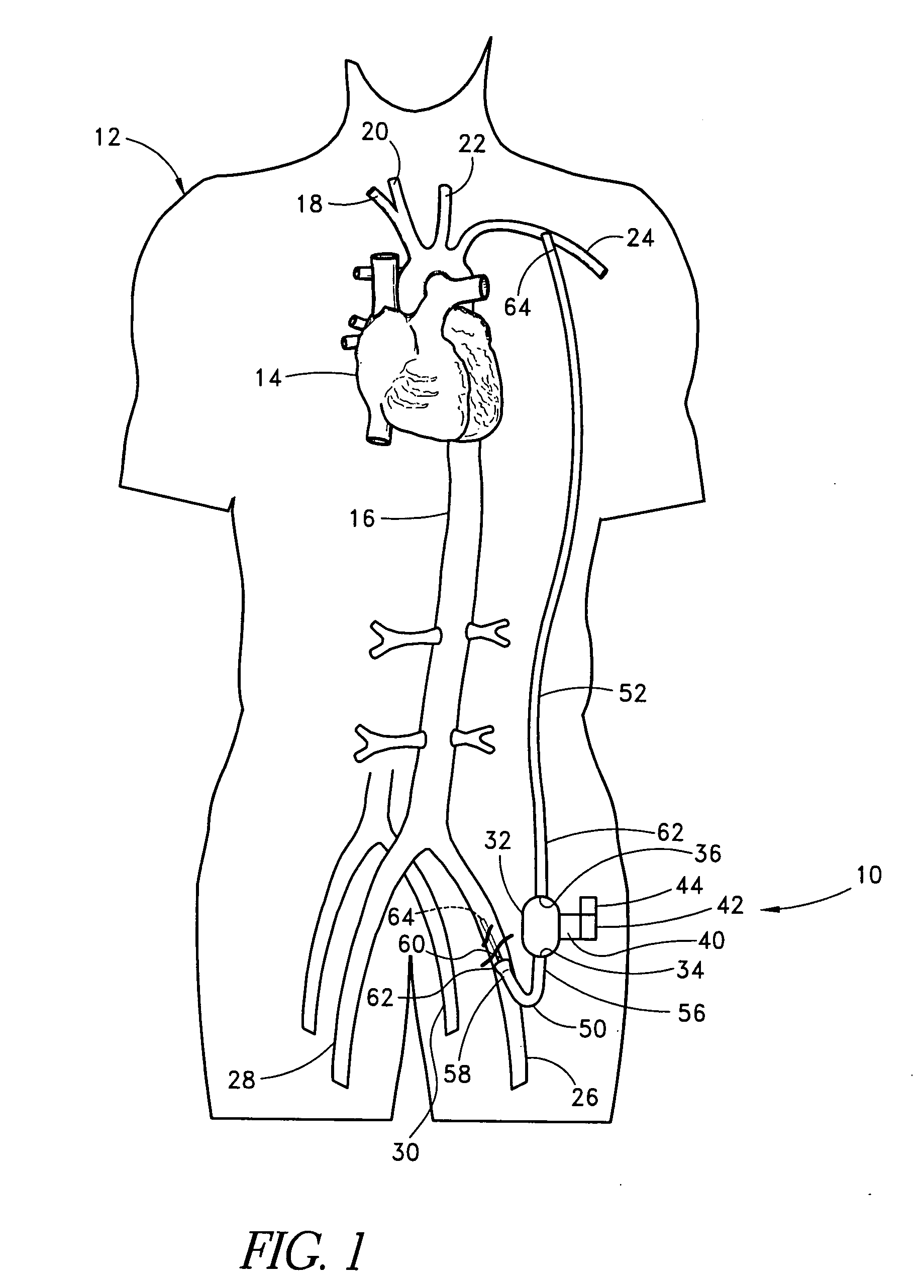 Methods for minimally invasive vascular access