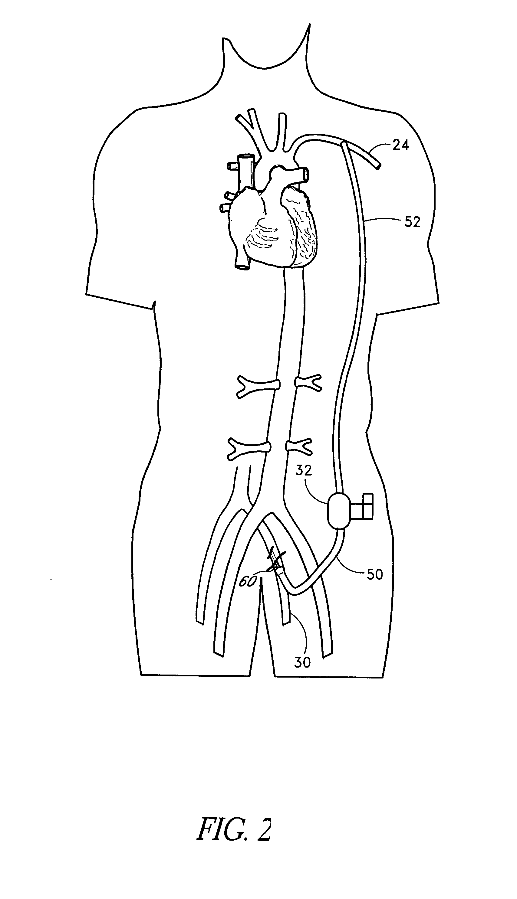 Methods for minimally invasive vascular access