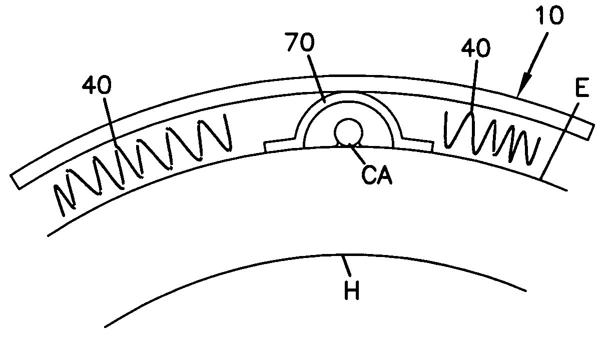 Cardiac wall tension relief device and method