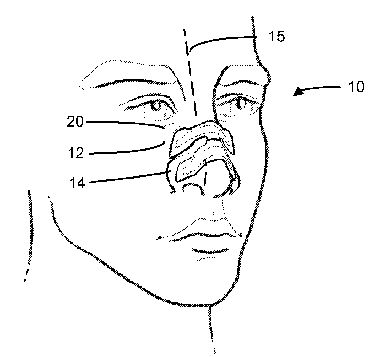 Nasal dilator