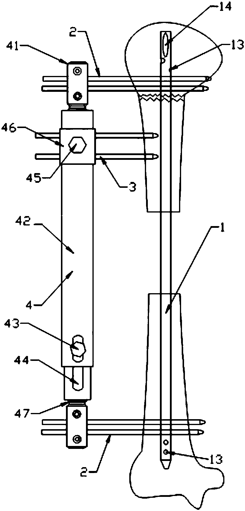 A bone handling device for large bone defects