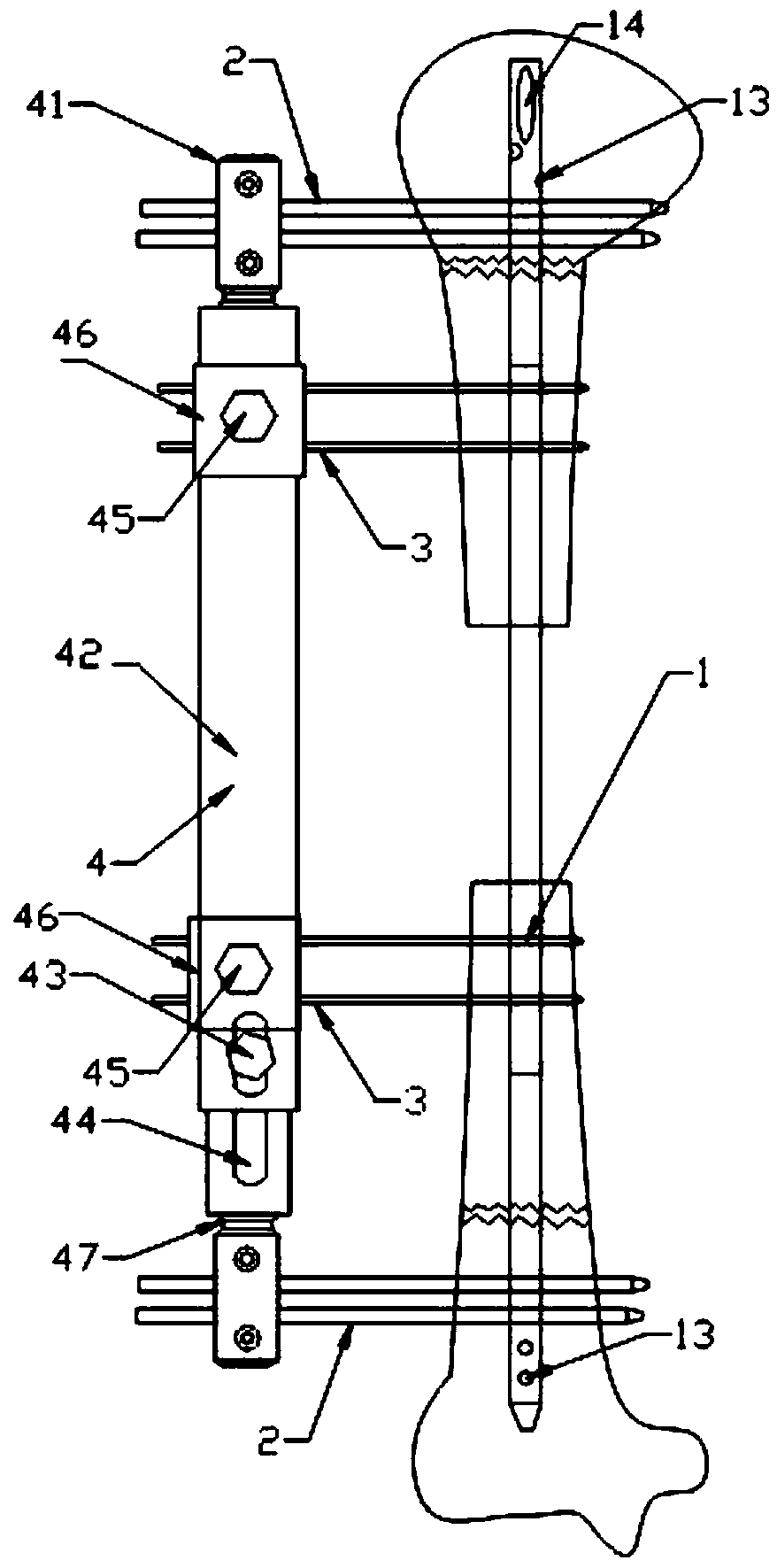 A bone handling device for large bone defects