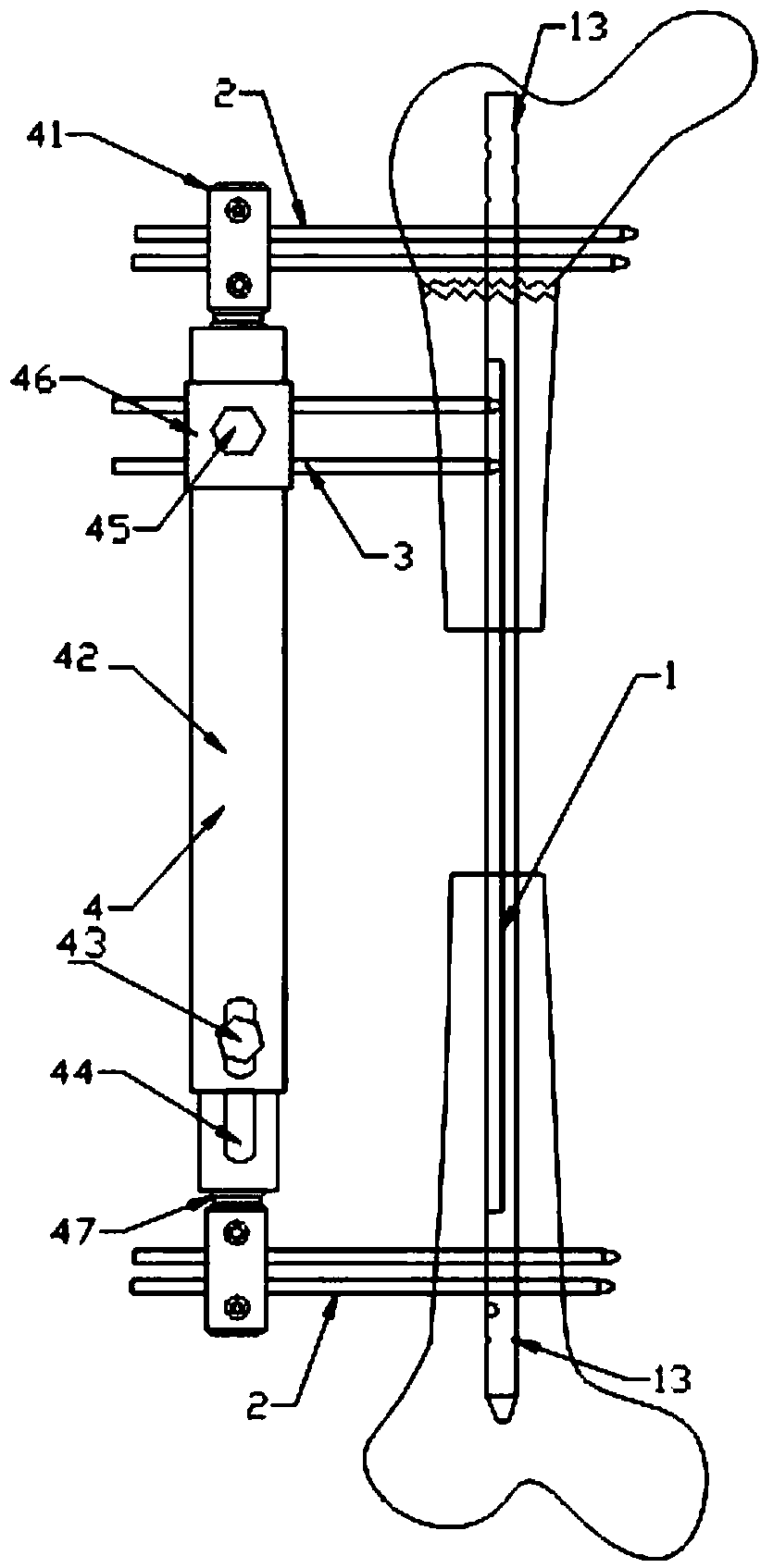 A bone handling device for large bone defects