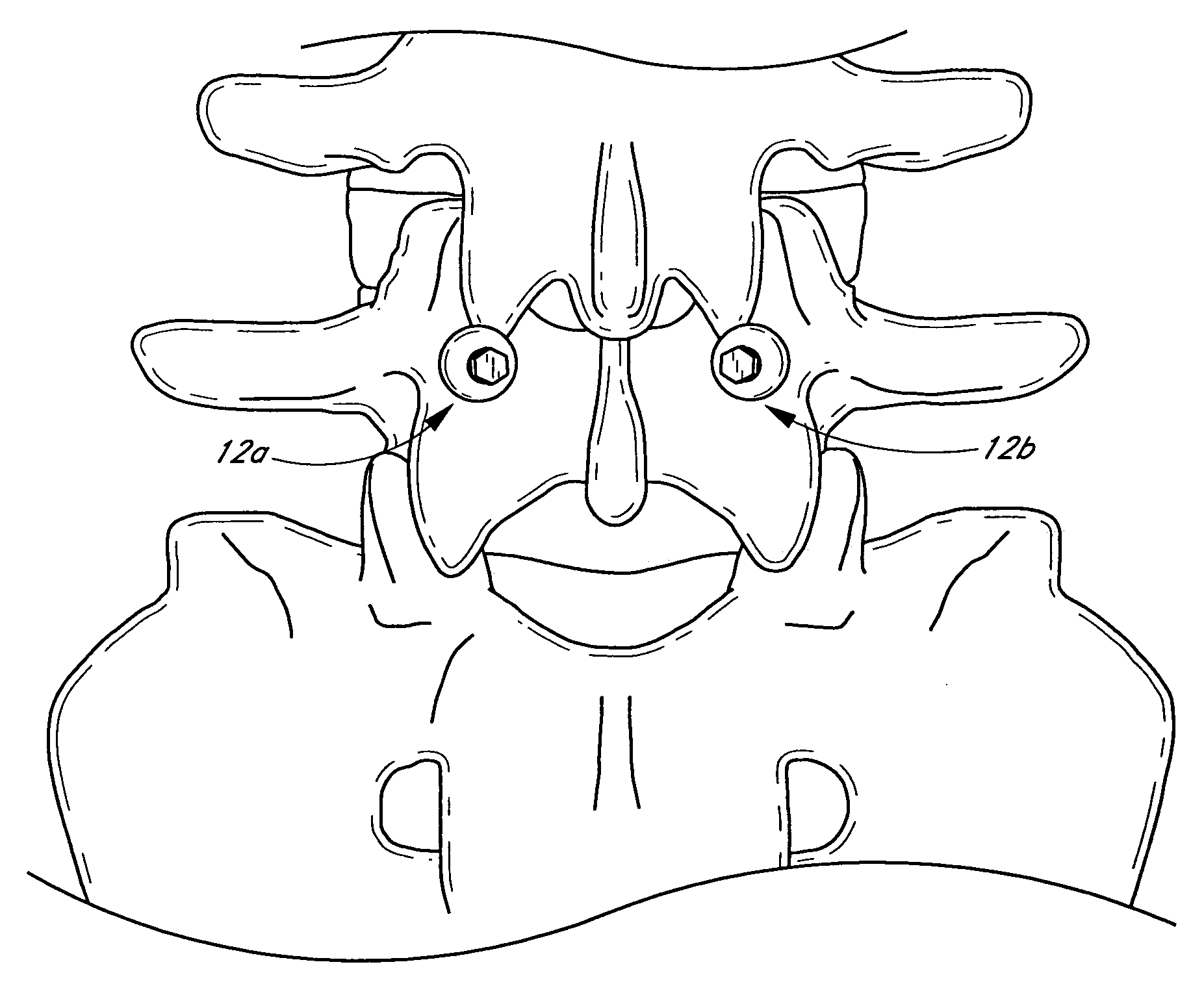 Method and apparatus for spinal stabilization