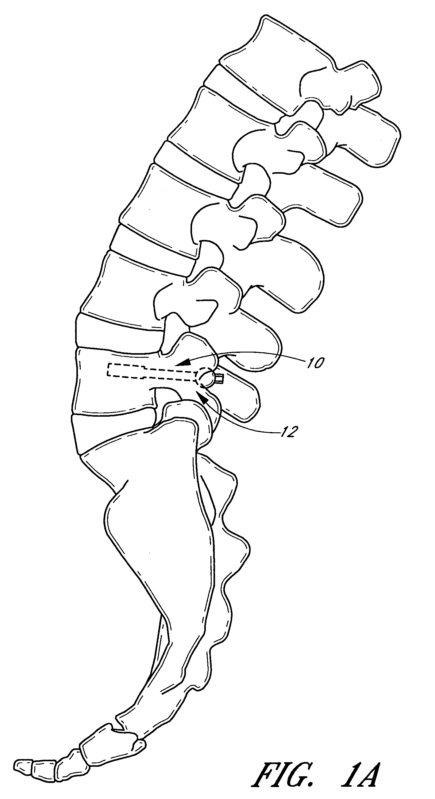 Method and apparatus for spinal stabilization