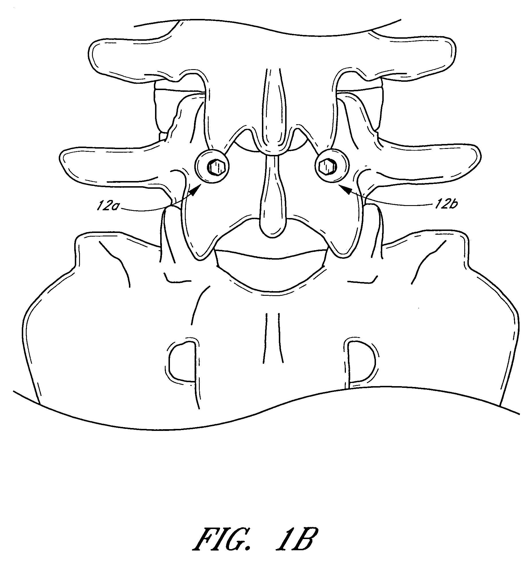 Method and apparatus for spinal stabilization